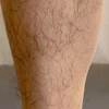 Leg hair