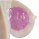 Gel-Filled Breast